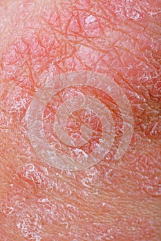 Psoriasis