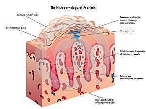 Psoriasis