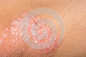 Psoriasis photo