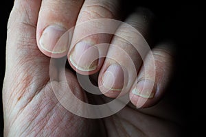 Psoriasis is an autoimmune disease that affects the nail and skin. close up of Psoriasis nail on dark background.