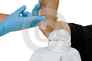 Psoriasis skin lesions photo