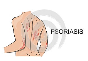 Psoriasis. Dermatology. Allergy.