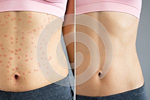 Psoriasis Disease Treatment Before After