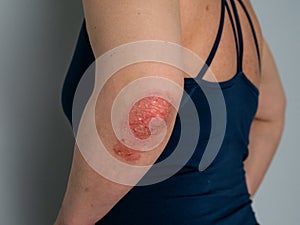 Psoriasis on elbow. Isolated. Closeup of rash and scaling on the patient`s skin. The concept of chronic disease treatment.