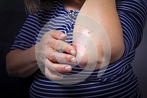 Psoriasis on elbow photo