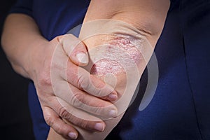 Psoriasis on elbow