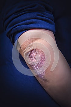 Psoriasis on elbow