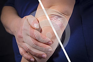 Psoriasis on elbow before and after