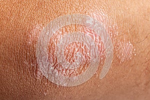 Psoriasis on elbow skin