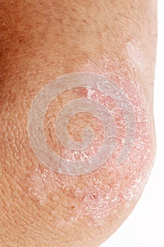 Psoriasis on elbow