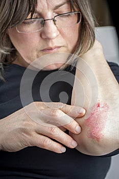 Psoriasis on elbow photo