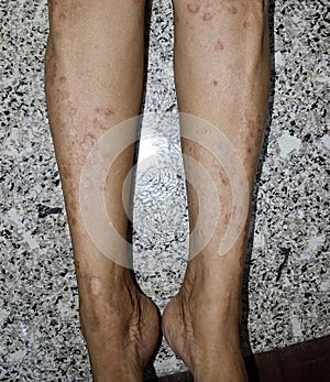 Psoriasis or Fungal Infection called Tinea Corporis on leg of Southeast Asian, Burmese adult woman.