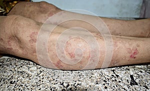 Psoriasis or Fungal Infection called Tinea Corporis on leg of Southeast Asian, Burmese adult woman.