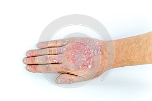 Psoriasis on the hand on white