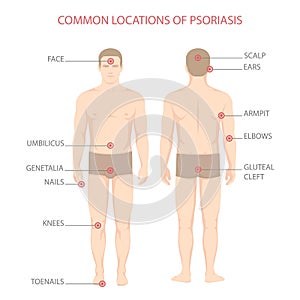 Psoriasis illness diagram