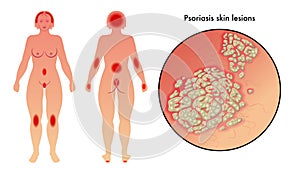 Psoriasis photo