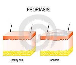 Psoriasis photo