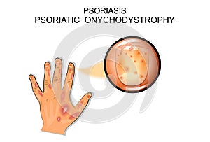 Psoriasis. psoriatic onychodystrophy photo