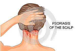 Psoriasis of the scalp
