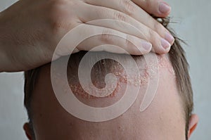 Psoriasis on the skin close-up, scalp, photos of dermatitis and eczema, skin problems, dermatology