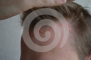 Psoriasis on the skin close-up, scalp, photos of dermatitis and eczema, skin problems, dermatology photo