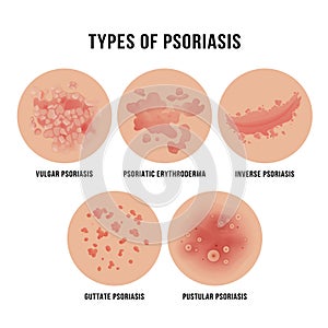 Psoriasis skin disease, types of derma problem photo