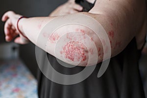 Psoriasis skin. Psoriasis is an autoimmune disease that affects the skin cause skin inflammation red and scaly. Eczema photo