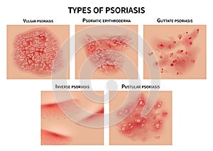 Psoriasis types. Skin hives, derma diseases. Closeup medical vector illustration