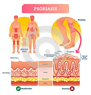 Psoriasis vector illustration. Skin disease and illness. Labeled structure. photo