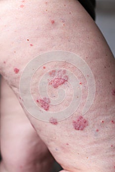 Psoriasis vulgaris is an autoimmune disease that affects the skin, detail photography for mainly medical magazines. Atopic dermati photo