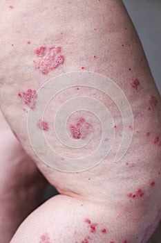 Psoriasis vulgaris is an autoimmune disease that affects the skin, detail photography for mainly medical magazines. Atopic dermati photo