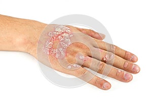 Psoriasis vulgaris on the male hand and finger nails with plaque, rash and patches, isolated on white background. Autoimmune genet photo