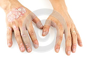 Psoriasis vulgaris on the mans hands with plaque, rash and patches, isolated on white background. Autoimmune genetic disease.