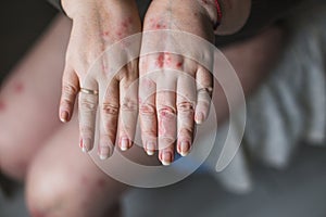 Psoriasis vulgaris on the womans hands with plaque, rash and patches on skin, isolated on white background. Autoimmune