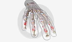 Psoriatic Arthritis Effects on Hand Joints