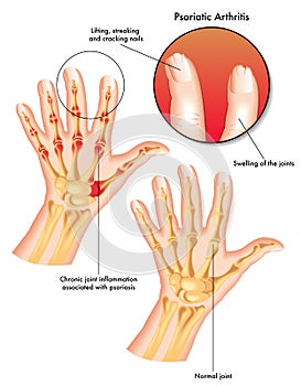 Psoriatic arthritis photo