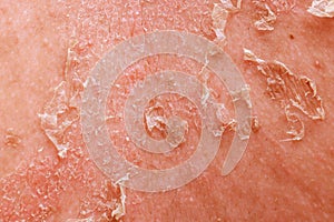 Psoriatic eczema is a complex skin disease that demands multidisciplinary approach in dermatology.