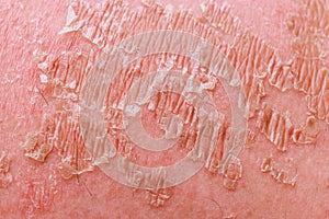 Psoriatic eczema dermatology skin problems disease