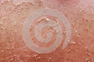 Psoriatic eczema is a disease characterized by skin problems inflammation.