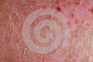 Psoriatic eczema is a skin condition that falls under realm of dermatology.