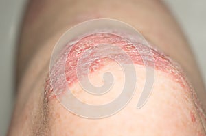 Psoriatic plaque on the skin of the knee. Close-up. Skin problems. Skin diseases.Soft focus