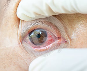 Pterygium in eye photo