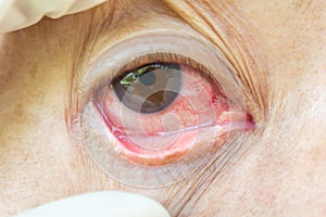 Pterygium in eye