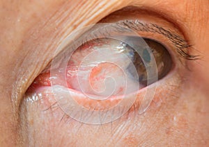 Pterygium in eye photo