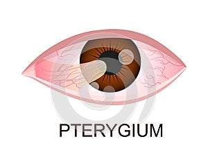 Pterygium growing onto the cornea. Conjunctival degeneration. Eye disease. Human organ of vision with pathology. Vector photo