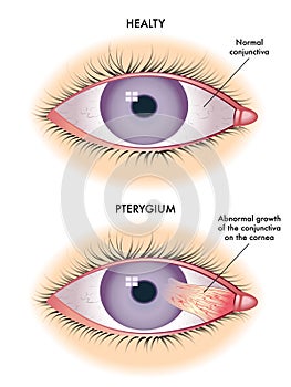 Pterygium