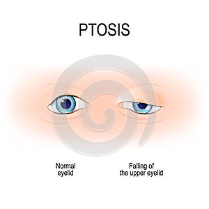 Ptosis is a drooping of the upper eyelid. lazy eye