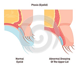 Ptosis. Drooping of the upper eyelid. Lazy eye caused by weakened