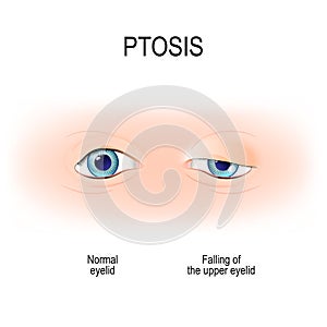 Ptosis is a drooping of the upper eyelid. lazy eye photo