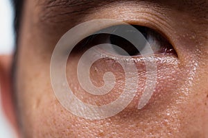 Ptosis Droopy eyelid in asian male oily skin type with dark eye bag